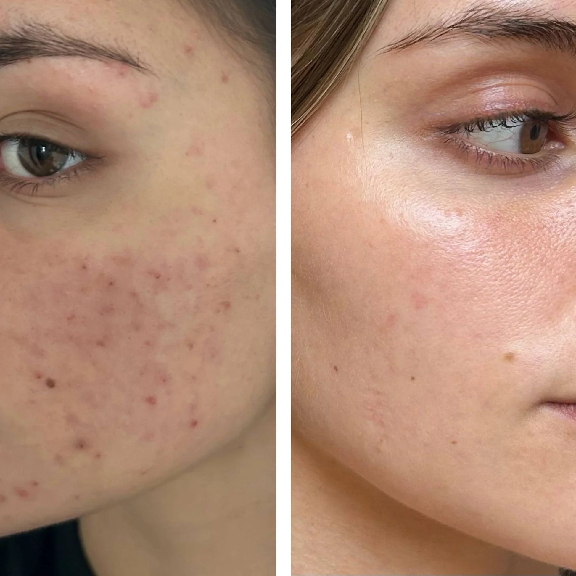 DermaLab - Acne Infusion 6 weken plan